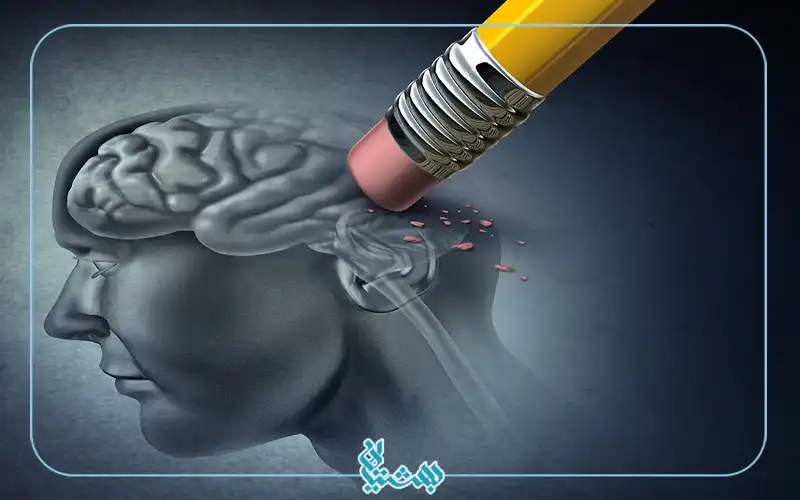 آلزایمر