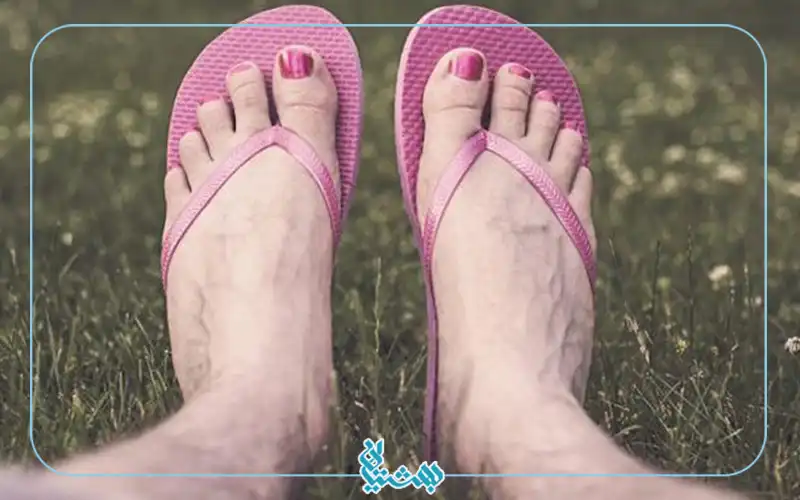 اختلال دگرجنس پوشی