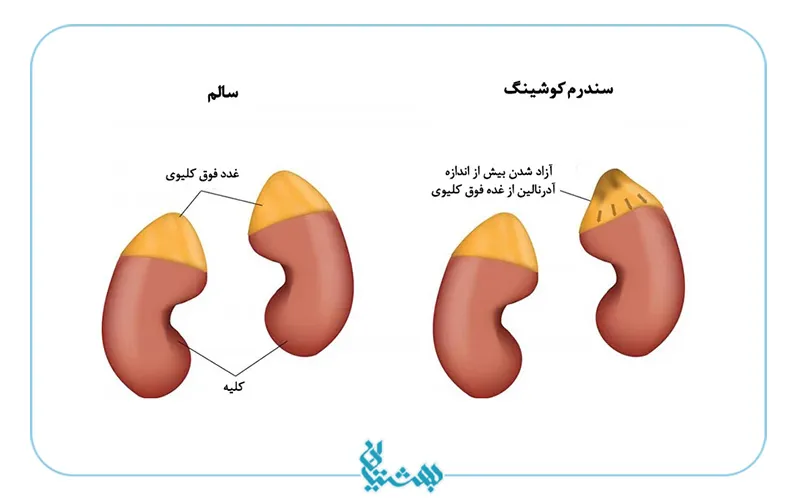 سطح کورتیزول بالا ناشی از آزاد شدن بیش از اندازه آدرنالین