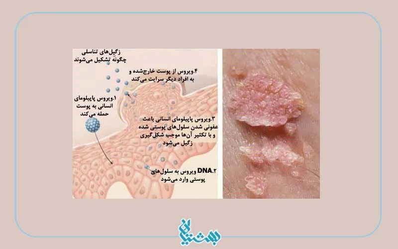 ویروس HPV  و چگونگی انتقال